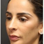 Aesthetic Facial Balancing Before & After Patient #1162