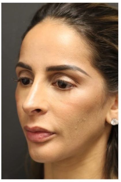 Aesthetic Facial Balancing Before & After Patient #1162