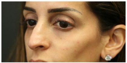 Aesthetic Facial Balancing Before & After Patient #1162