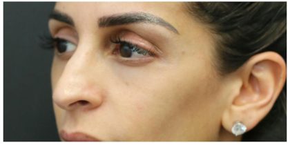 Aesthetic Facial Balancing Before & After Patient #1162