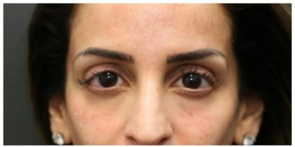 Aesthetic Facial Balancing Before & After Patient #1162