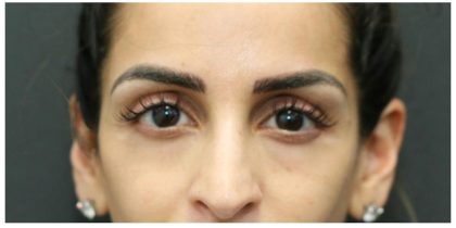 Aesthetic Facial Balancing Before & After Patient #1162