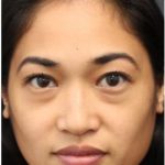 Aesthetic Facial Balancing Before & After Patient #1161