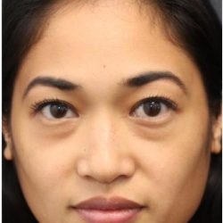Aesthetic Facial Balancing Before & After Patient #1161