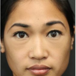 Aesthetic Facial Balancing Before & After Patient #1161