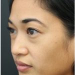 Aesthetic Facial Balancing Before & After Patient #1161