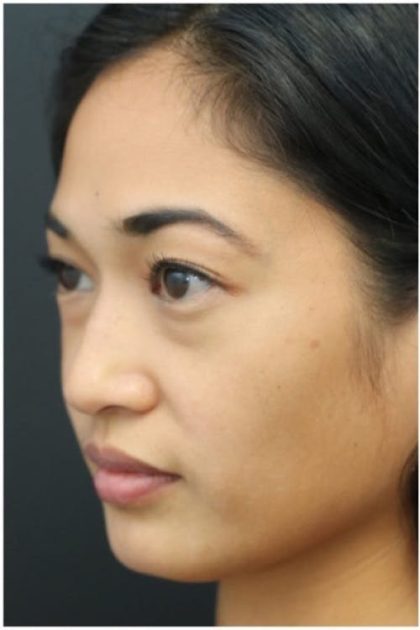 Aesthetic Facial Balancing Before & After Patient #1161