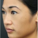 Aesthetic Facial Balancing Before & After Patient #1161