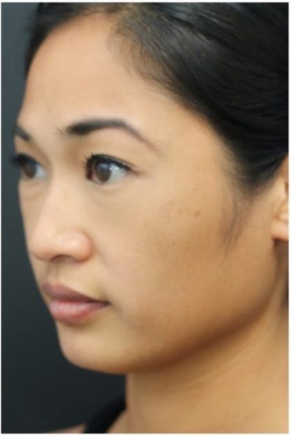 Aesthetic Facial Balancing Before & After Patient #1161