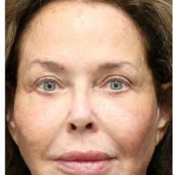 Aesthetic Facial Balancing Before & After Patient #1160