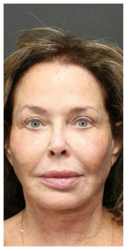 Aesthetic Facial Balancing Before & After Patient #1160
