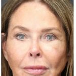 Aesthetic Facial Balancing Before & After Patient #1160