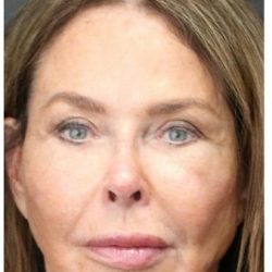 Aesthetic Facial Balancing Before & After Patient #1160