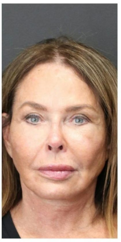 Aesthetic Facial Balancing Before & After Patient #1160