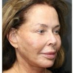 Aesthetic Facial Balancing Before & After Patient #1160