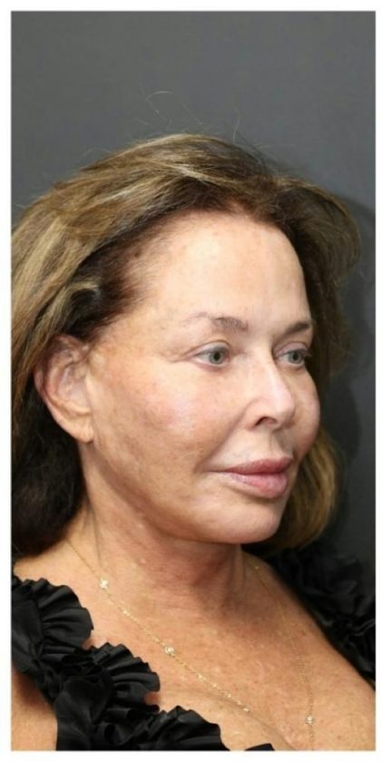 Aesthetic Facial Balancing Before & After Patient #1160