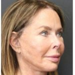 Aesthetic Facial Balancing Before & After Patient #1160