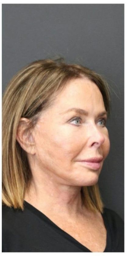 Aesthetic Facial Balancing Before & After Patient #1160