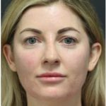 Aesthetic Facial Balancing Before & After Patient #1159