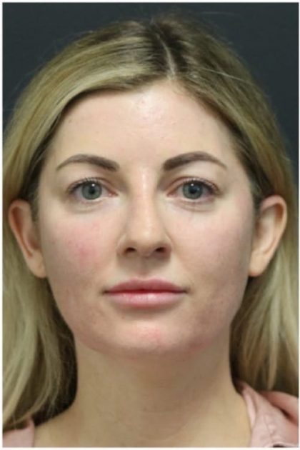 Aesthetic Facial Balancing Before & After Patient #1159