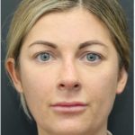 Aesthetic Facial Balancing Before & After Patient #1159