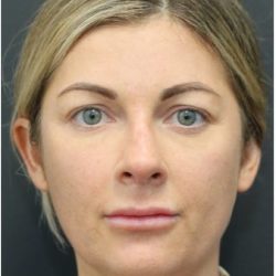 Aesthetic Facial Balancing Before & After Patient #1159