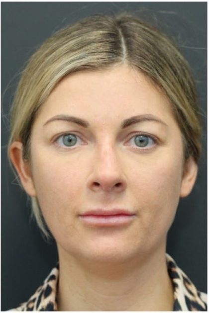Aesthetic Facial Balancing Before & After Patient #1159