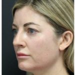 Aesthetic Facial Balancing Before & After Patient #1159
