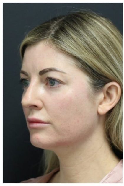 Aesthetic Facial Balancing Before & After Patient #1159