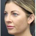 Aesthetic Facial Balancing Before & After Patient #1159