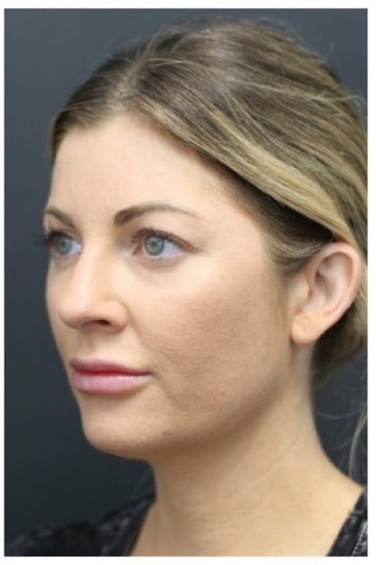 Aesthetic Facial Balancing Before & After Patient #1159
