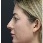 Aesthetic Facial Balancing Before & After Patient #1159