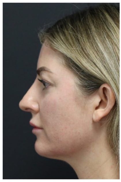 Aesthetic Facial Balancing Before & After Patient #1159