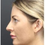 Aesthetic Facial Balancing Before & After Patient #1159