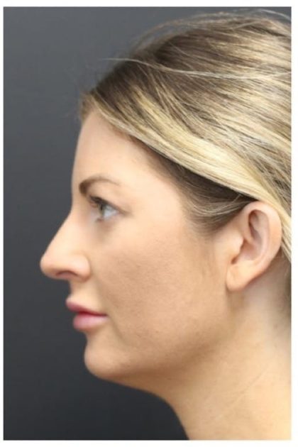 Aesthetic Facial Balancing Before & After Patient #1159