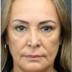 Aesthetic Facial Balancing Before & After Patient #1158