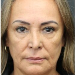 Aesthetic Facial Balancing Before & After Patient #1158