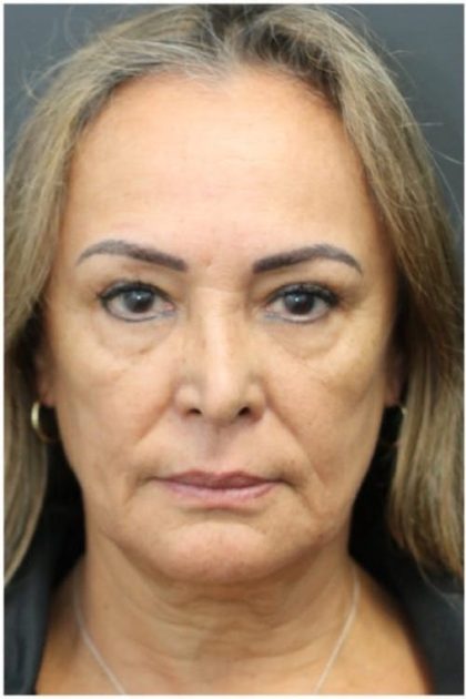 Aesthetic Facial Balancing Before & After Patient #1158