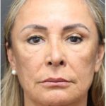 Aesthetic Facial Balancing Before & After Patient #1158