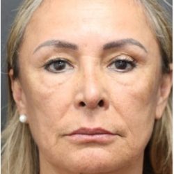 Aesthetic Facial Balancing Before & After Patient #1158
