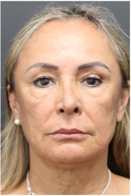Aesthetic Facial Balancing Before & After Patient #1158