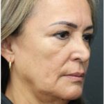 Aesthetic Facial Balancing Before & After Patient #1158