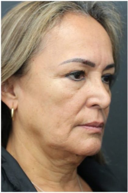 Aesthetic Facial Balancing Before & After Patient #1158