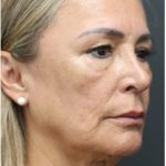 Aesthetic Facial Balancing Before & After Patient #1158