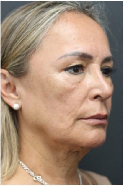 Aesthetic Facial Balancing Before & After Patient #1158