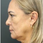 Aesthetic Facial Balancing Before & After Patient #1158