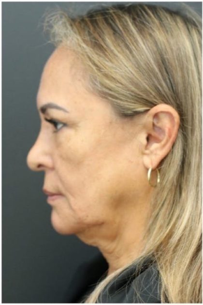 Aesthetic Facial Balancing Before & After Patient #1158