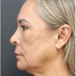 Aesthetic Facial Balancing Before & After Patient #1158