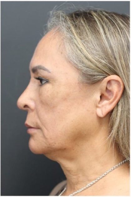 Aesthetic Facial Balancing Before & After Patient #1158