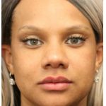 Aesthetic Facial Balancing Before & After Patient #1157